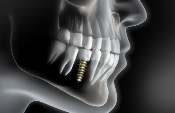 Zahnarzt Implantate