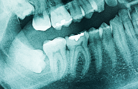 Oralchirurgie Röntgen